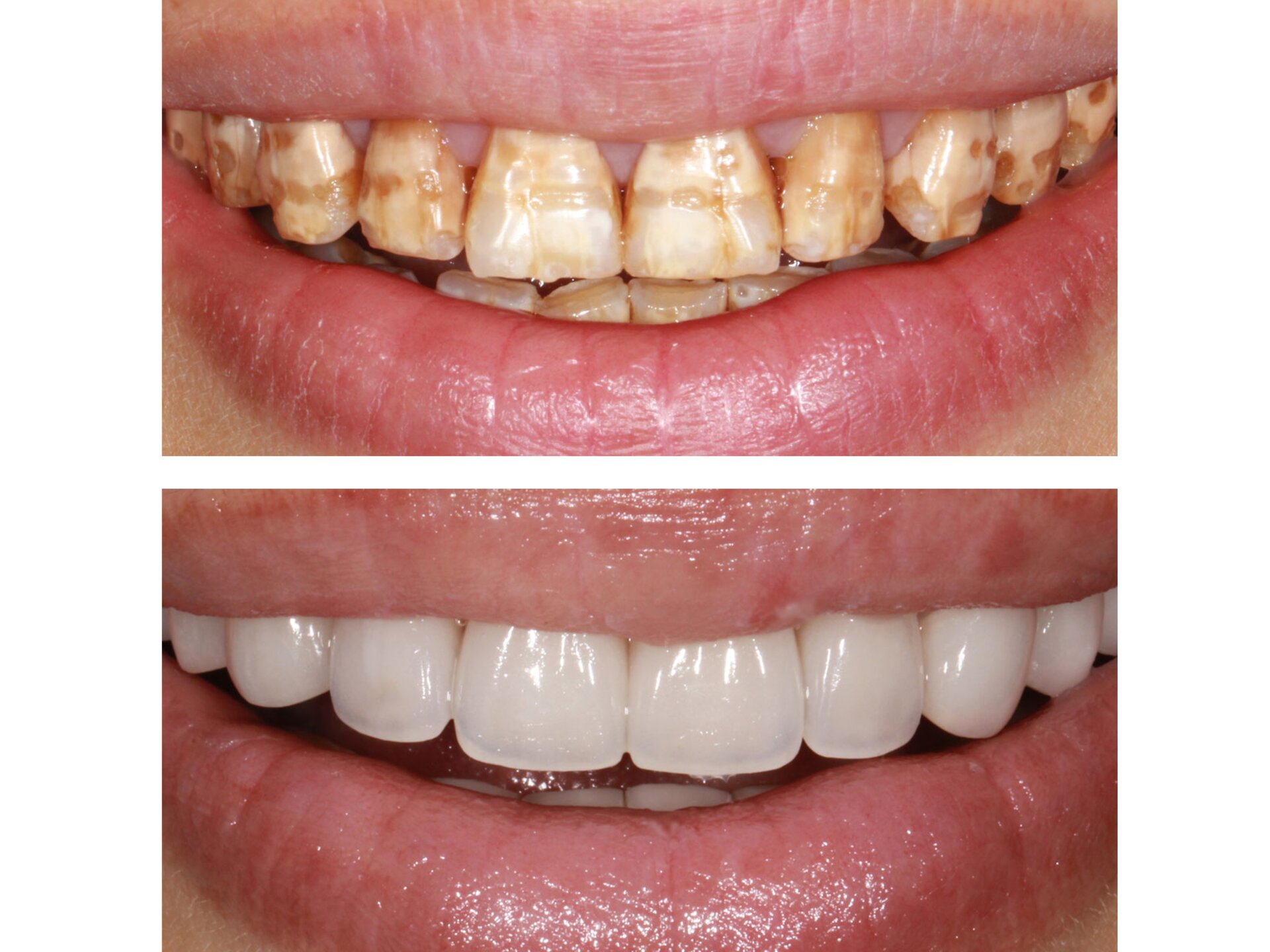 IPS e.max Press | Glass-ceramic restorations | Ivoclar US